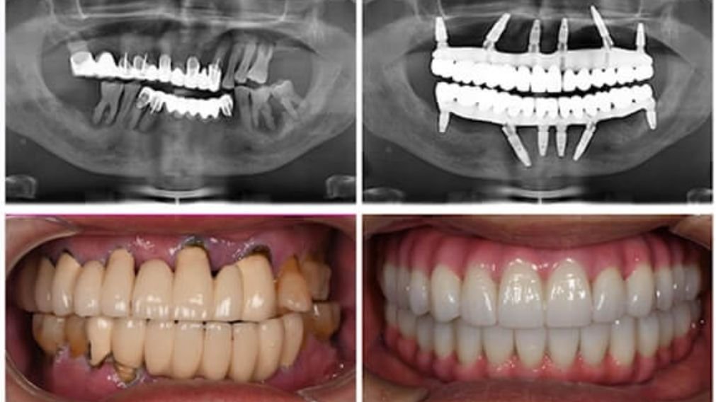 Antes e depois de um implante dentário do tipo protocolo all on 6