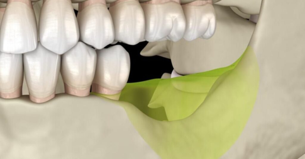 Tipos de enxerto ósseo para implante dentário com pouco osso e preço