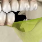 Tipos de enxerto ósseo para implante dentário com pouco osso e preço