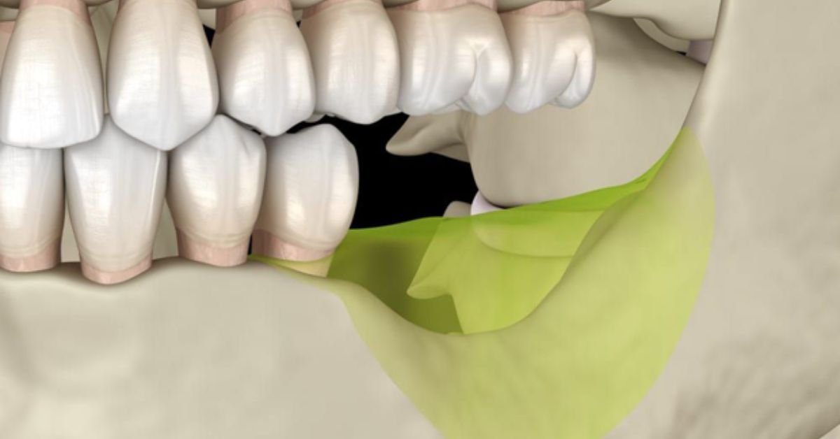 Tipos de enxerto ósseo para implante dentário com pouco osso e preço