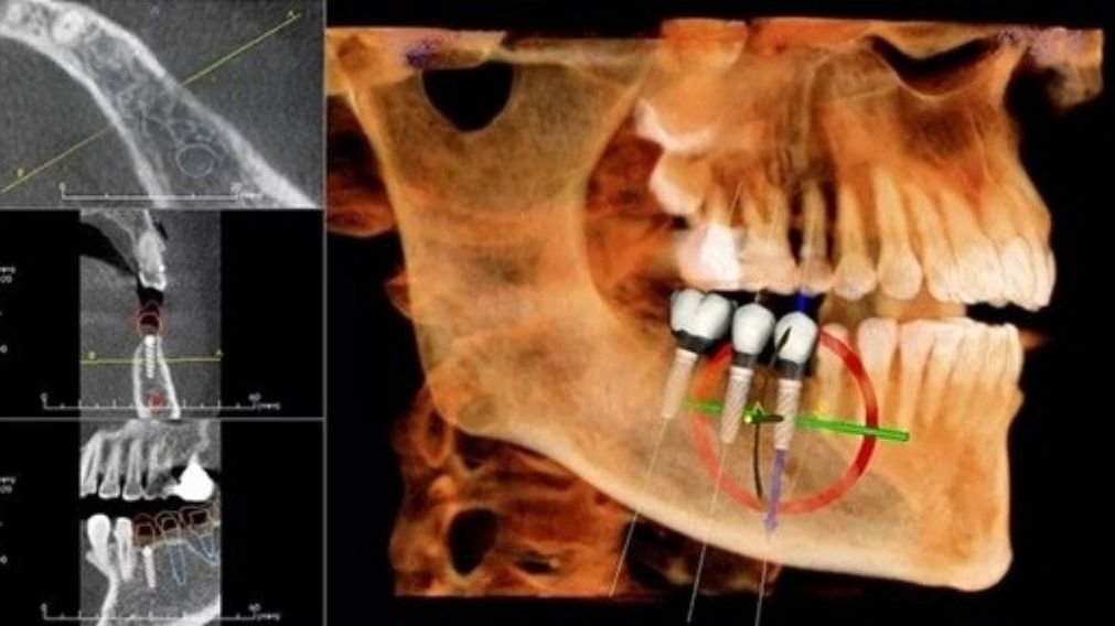 Tomografia computadorizada 3D para planejamento de implante dentário com carga imediata - avaliação da qualidade óssea