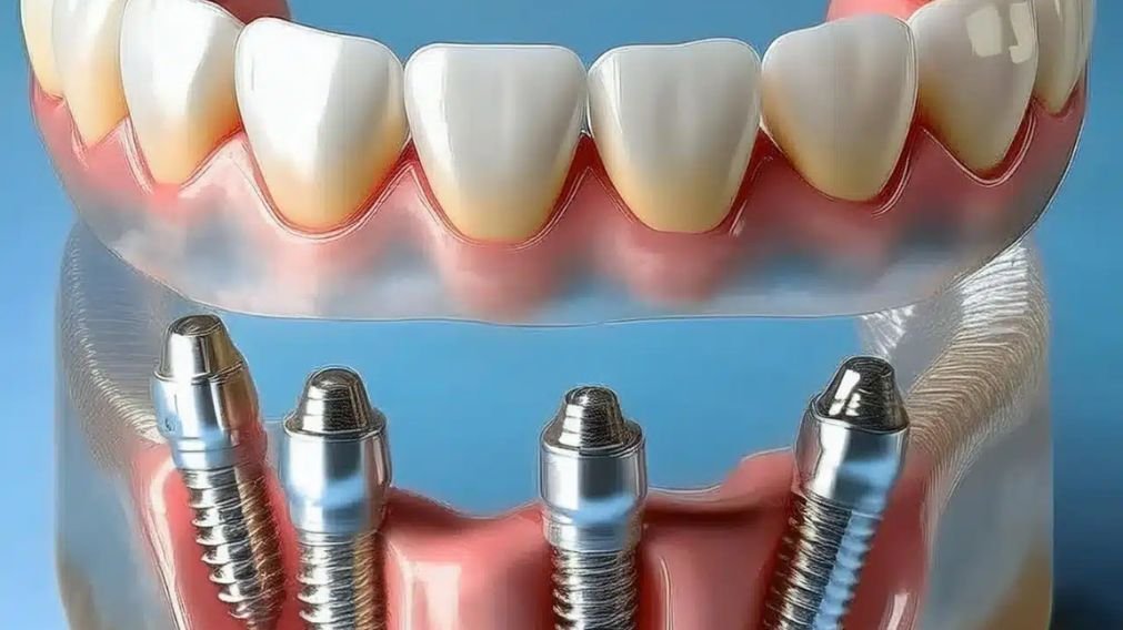 Implante Dentário All-on-4 em São Paulo - prótese fixa sobre implantes