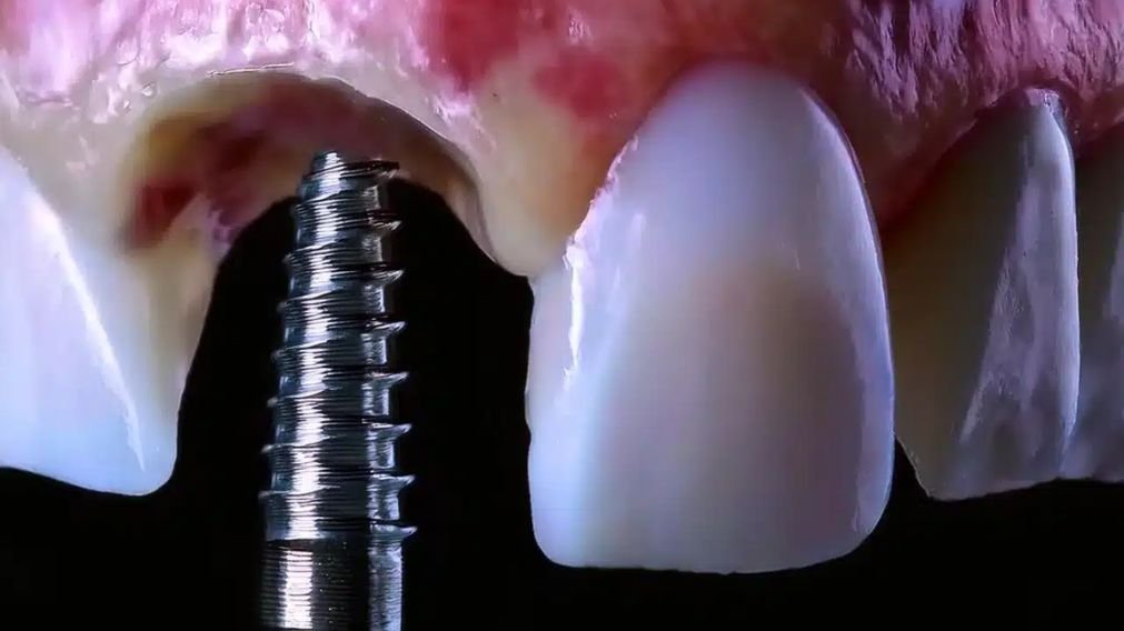 Dente no mesmo dia com a técnica de implante dentário com carga imediata