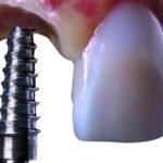 carga imediata implante e dente no mesmo dia