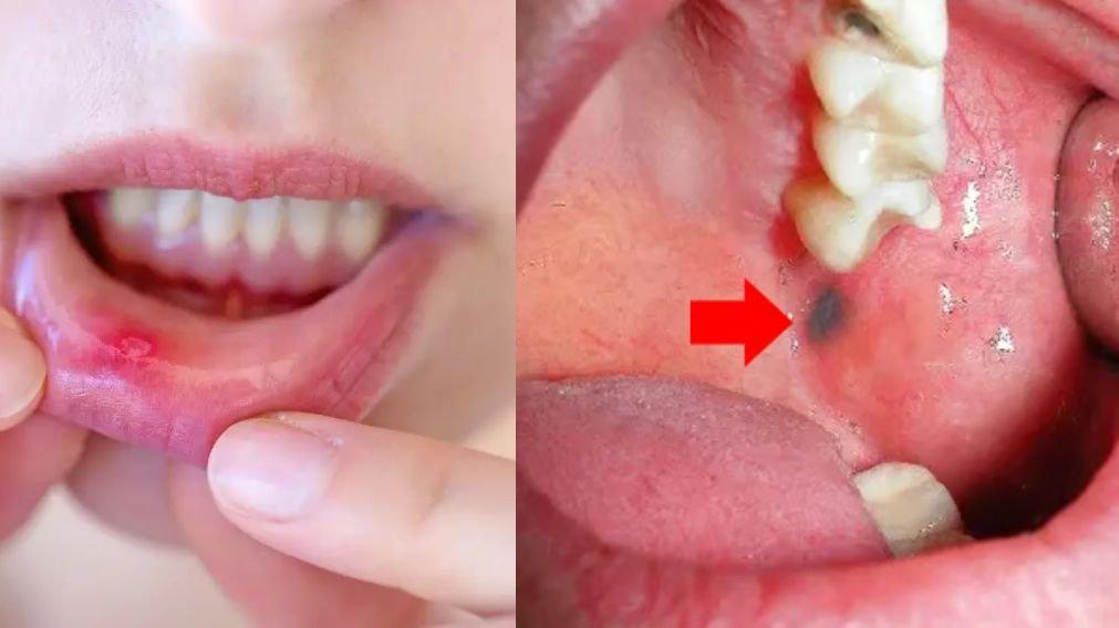 Comparação visual entre afta comum (benigna) e lesão suspeita Comparação visual entre afta comum (benigna) e lesão suspeita na boca que requer avaliação de estomatologista