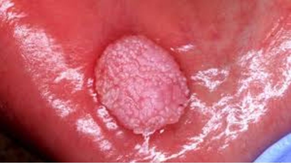 Foto clínica de papiloma escamoso oral na língua, mostrando lesão elevada com superfície irregular característica