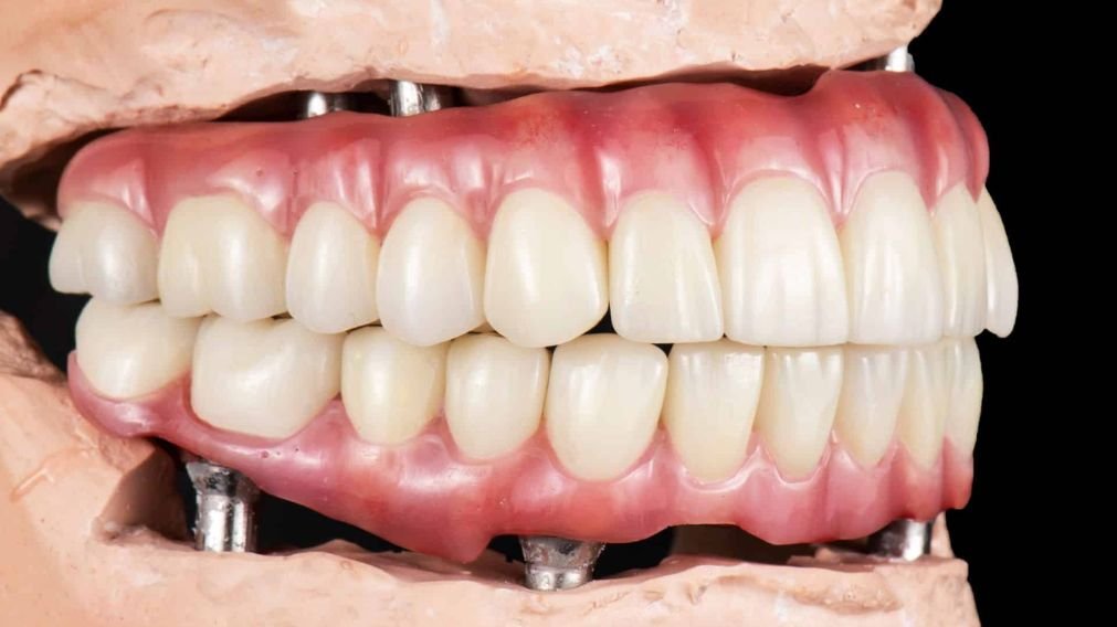 Prótese Protocolo - Resultado Final do Tratamento