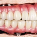 Resultado do tratamento com prótese protocolo: sorriso natural, seguro e fixo