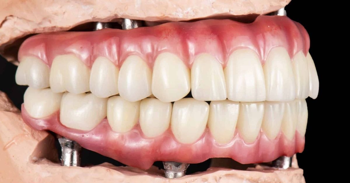 Resultado do tratamento com prótese protocolo: sorriso natural, seguro e fixo