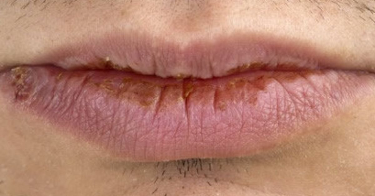 Queilite actínica no lábio inferior mostrando ressecamento, textura áspera e perda da definição da borda labial, lesão pré-cancerosa causada por exposição solar