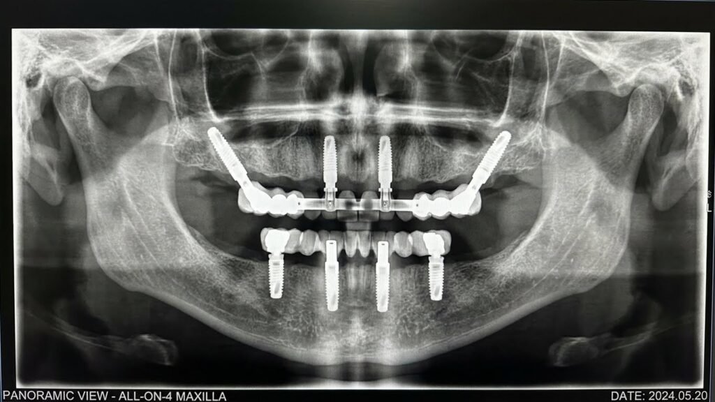 Radiografia panorâmica mostrando prótese protocolo parafusada sobre 4 implantes dentários