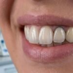 Prótese dentária de zircônia ou Porcelana qual a melhor?