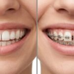 invisalign para o tratamento de diastema