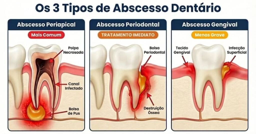 Tipos de Abscesso dentário