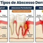 Tipos de Abscesso dentário
