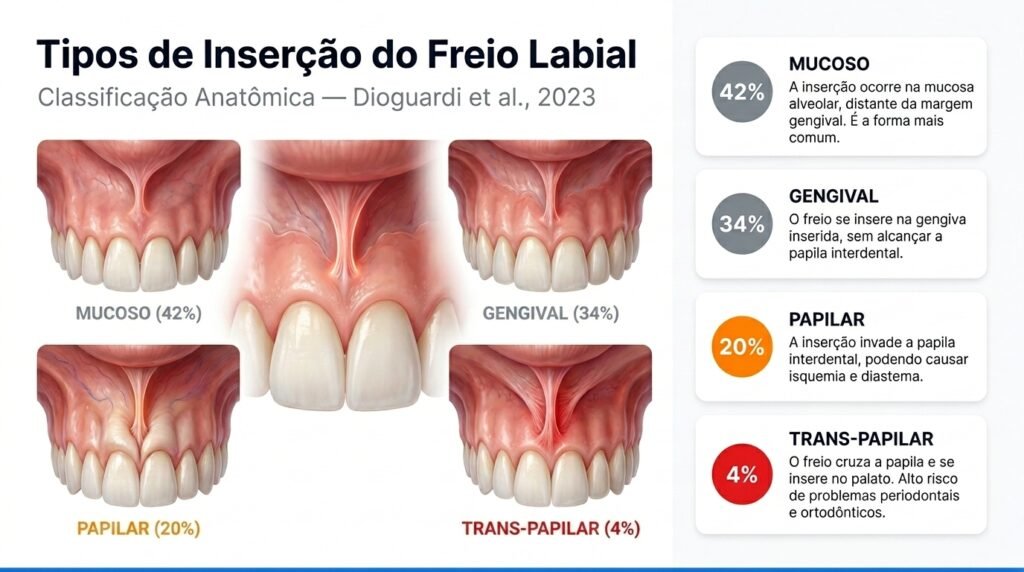 Infográfico mostrando os 4 tipos de inserção do freio labial: mucosa (42%), gengival (34%), papilar (20%) e transpapilar (4%)