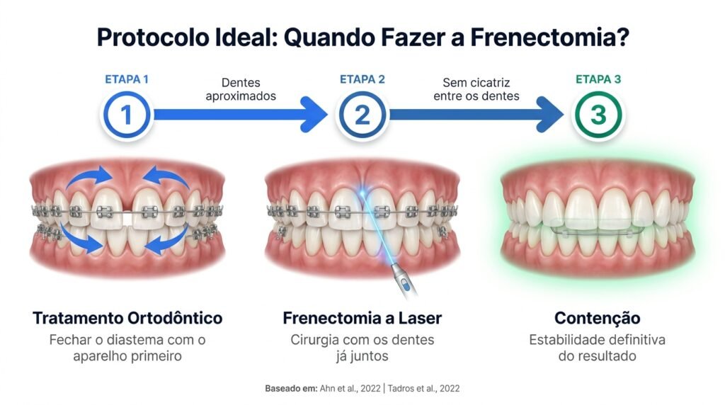 Infográfico com as 3 etapas do protocolo ortodôntico para fechamento de diastema: aparelho, frenectomia a laser e contenção