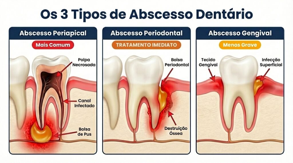 Infográfico comparando os 3 tipos de abscesso dentário: periapical, periodontal e gengival, com ilustrações anatômicas de cada localização