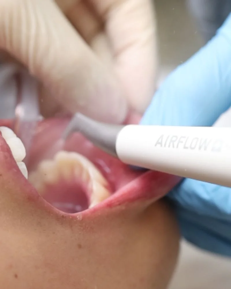 Limpeza dental com airflow