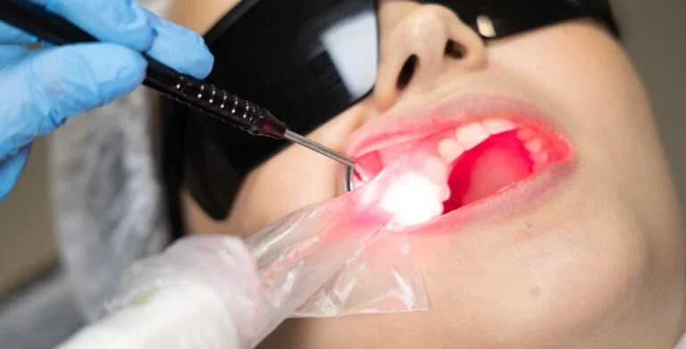 Tratamento da Gengivite com Laser