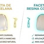 Lente de Contato Dental ou Faceta de Resina