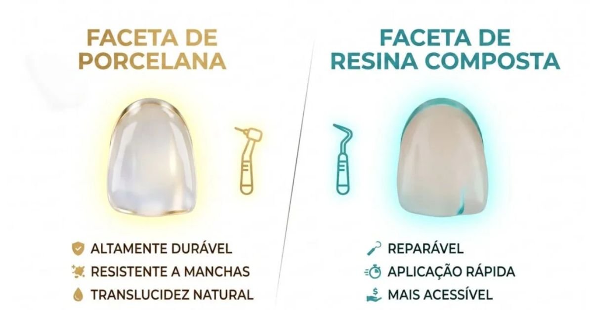 Lente de Contato Dental ou Faceta de Resina