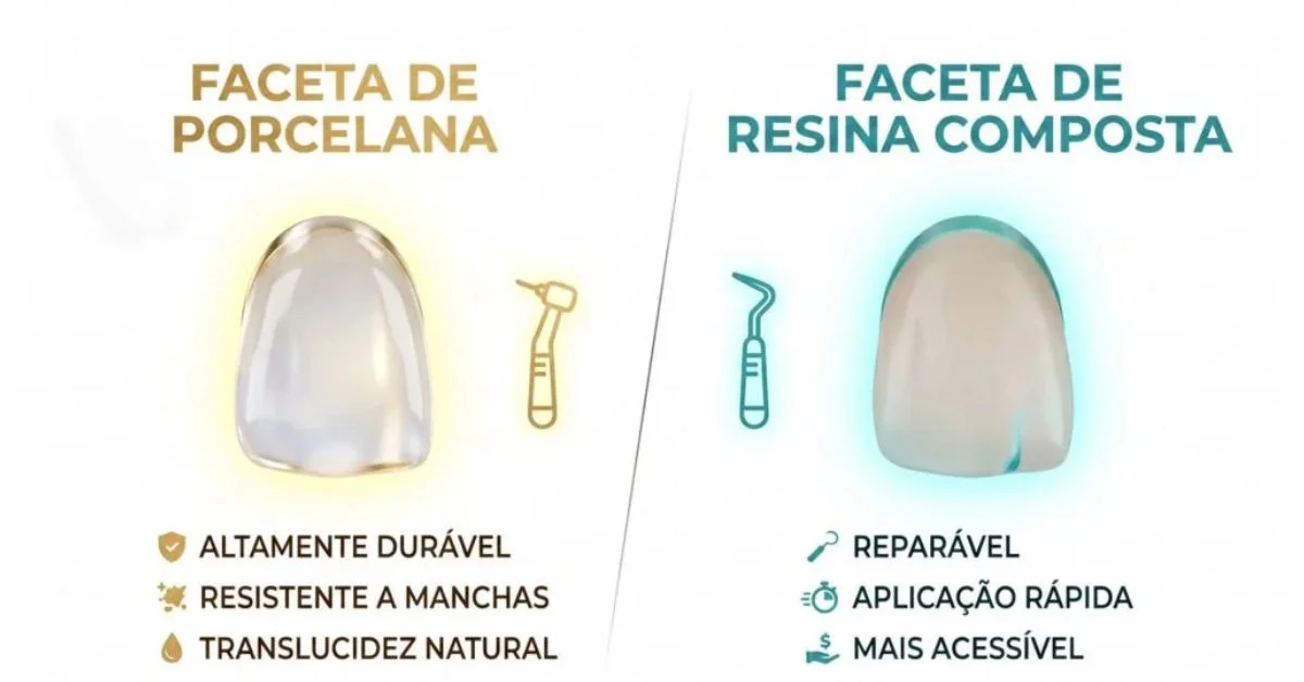 Lente de Contato Dental ou Faceta de Resina