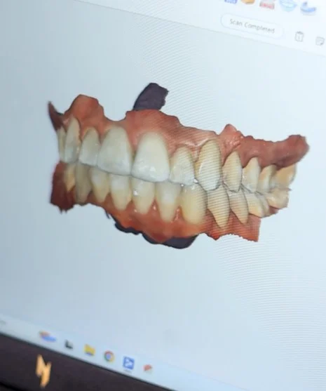 Monitor exibindo planejamento 3D de implante dentário