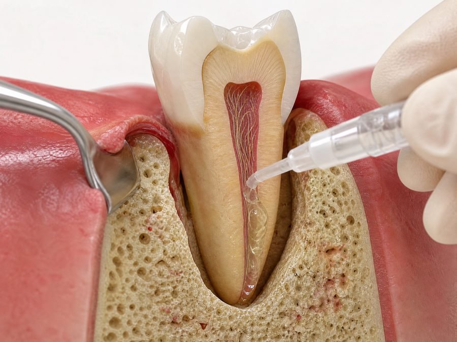 Aplicação do Emdogain — gel biológico sobre a superfície radicular