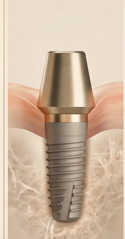 Representação visual de cuidado periodontal com implantes