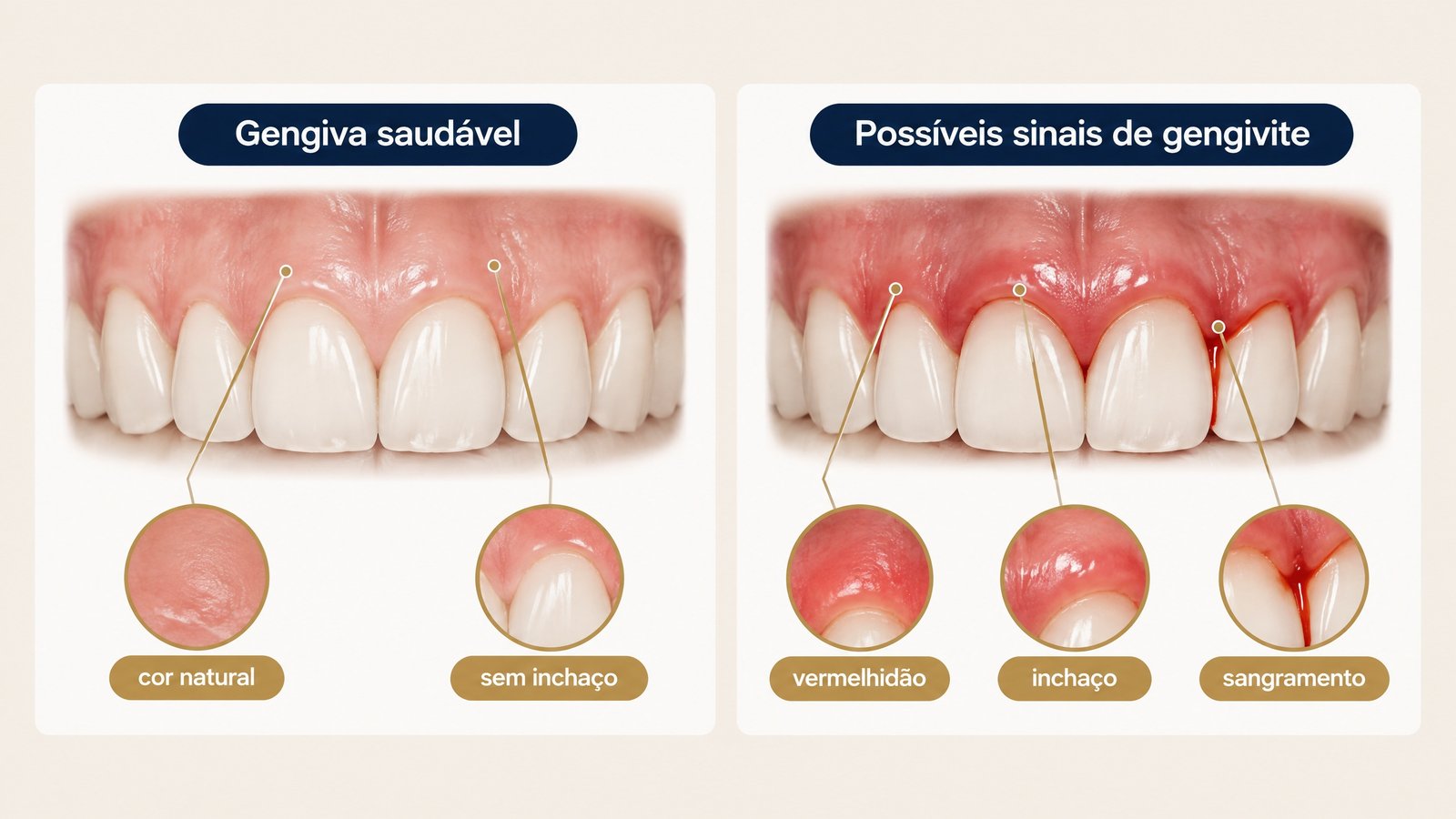 Comparação ampliada entre gengiva saudável e possíveis sinais de gengivite