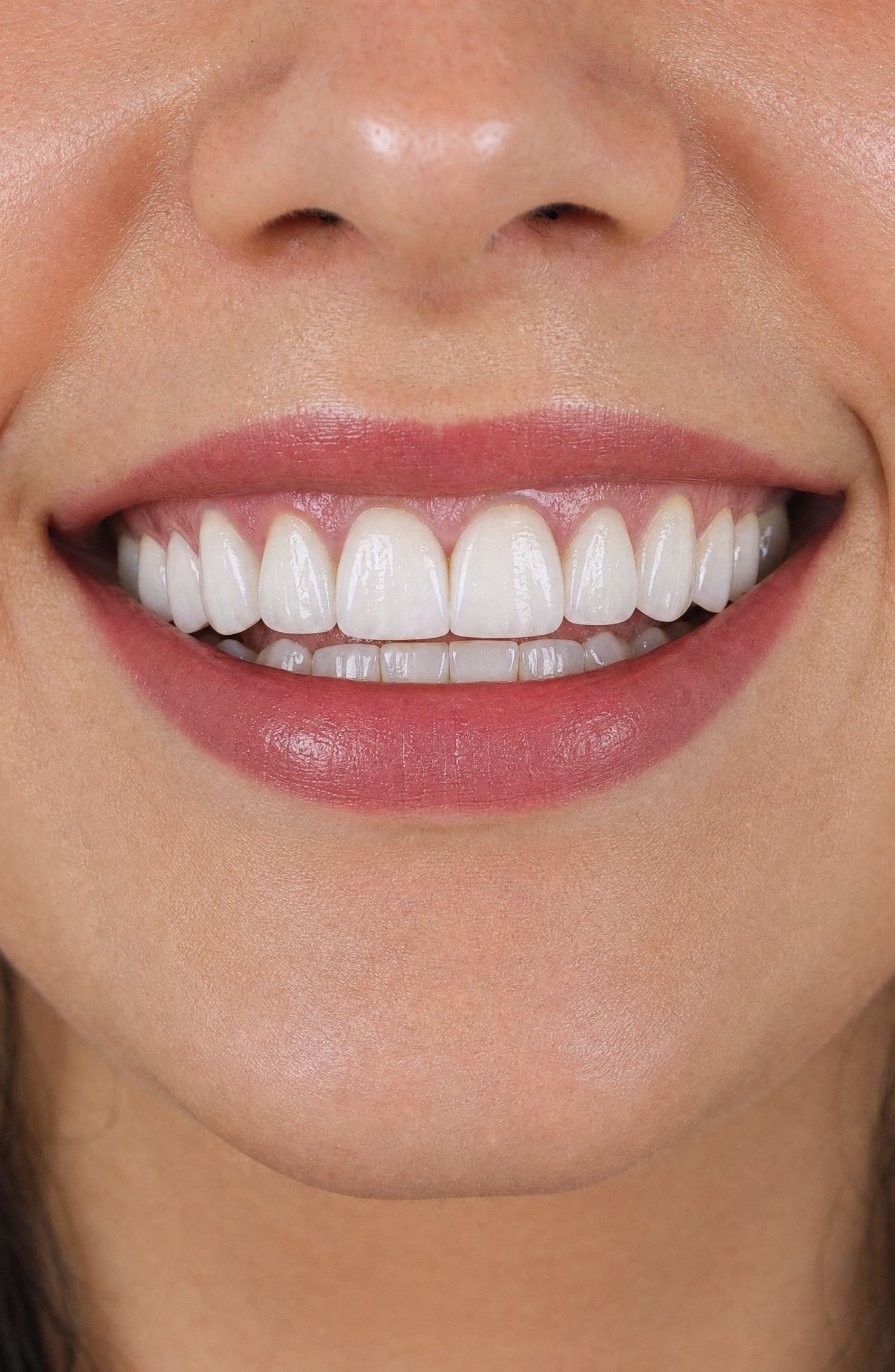 Paciente sorrindo com resultado natural de facetas de resina