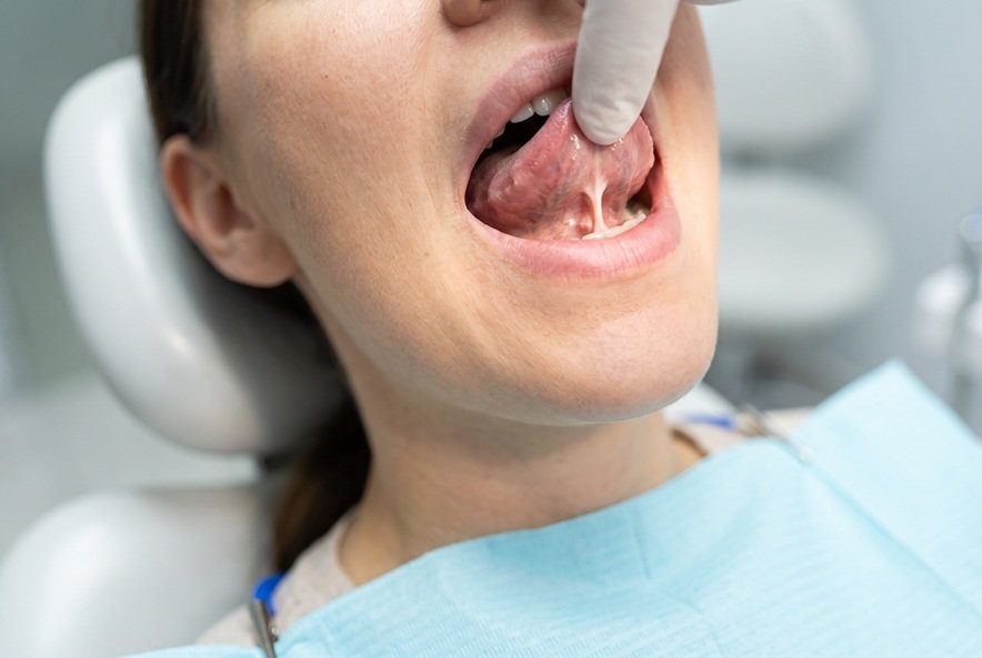 Frenectomia Lingual em Adultos — Língua Presa — Flori Odontologia