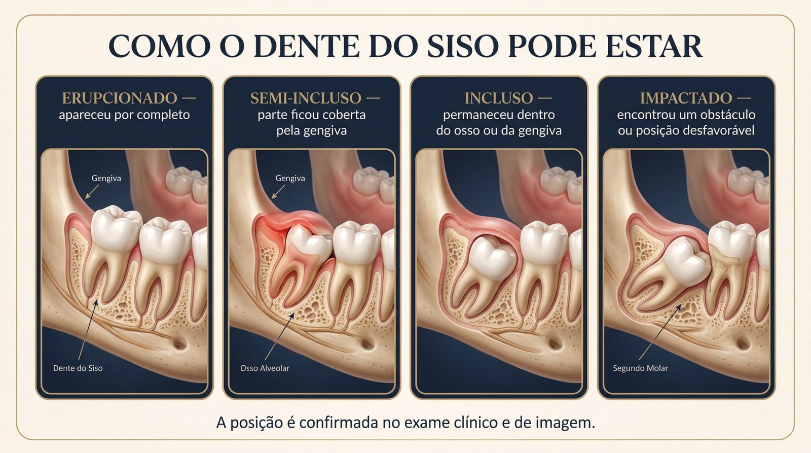 Comparação entre siso erupcionado, semi-incluso, incluso e impactado