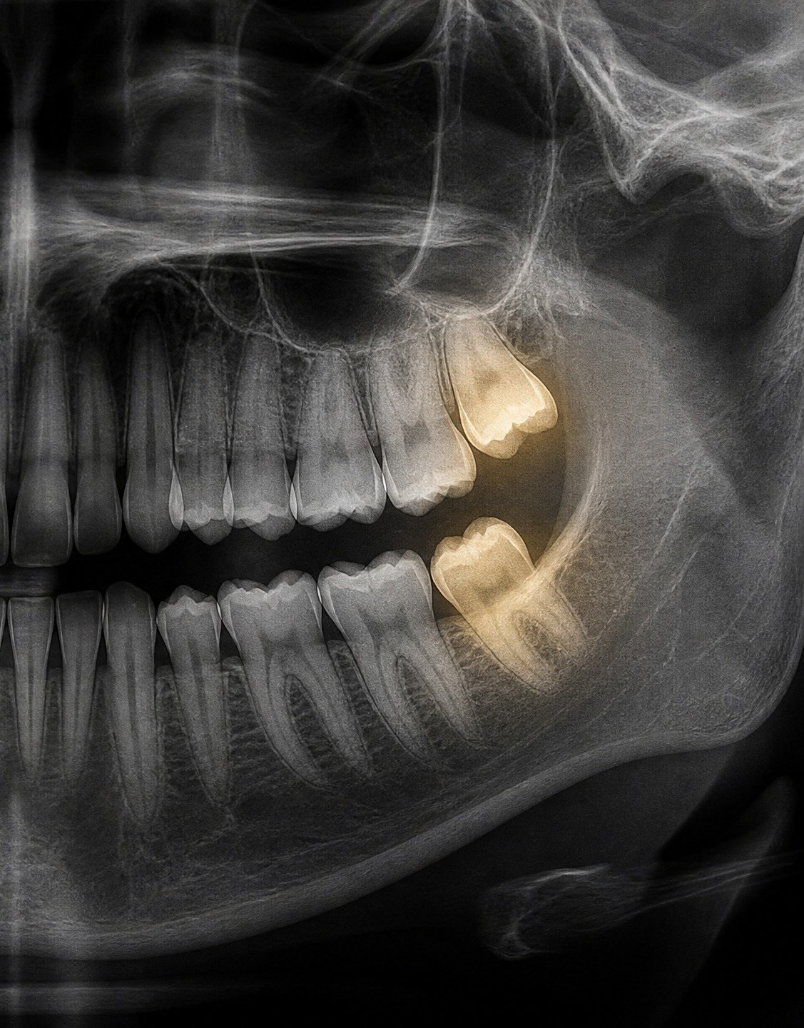 Avaliação para extração de siso na Flori Odontologia