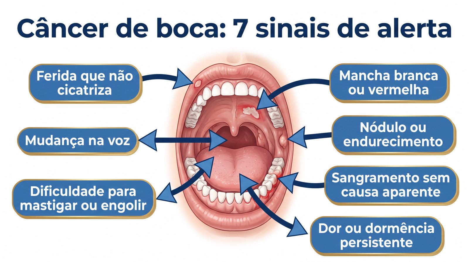 Infográfico anatômico com 7 sinais iniciais de câncer de boca que merecem investigação
