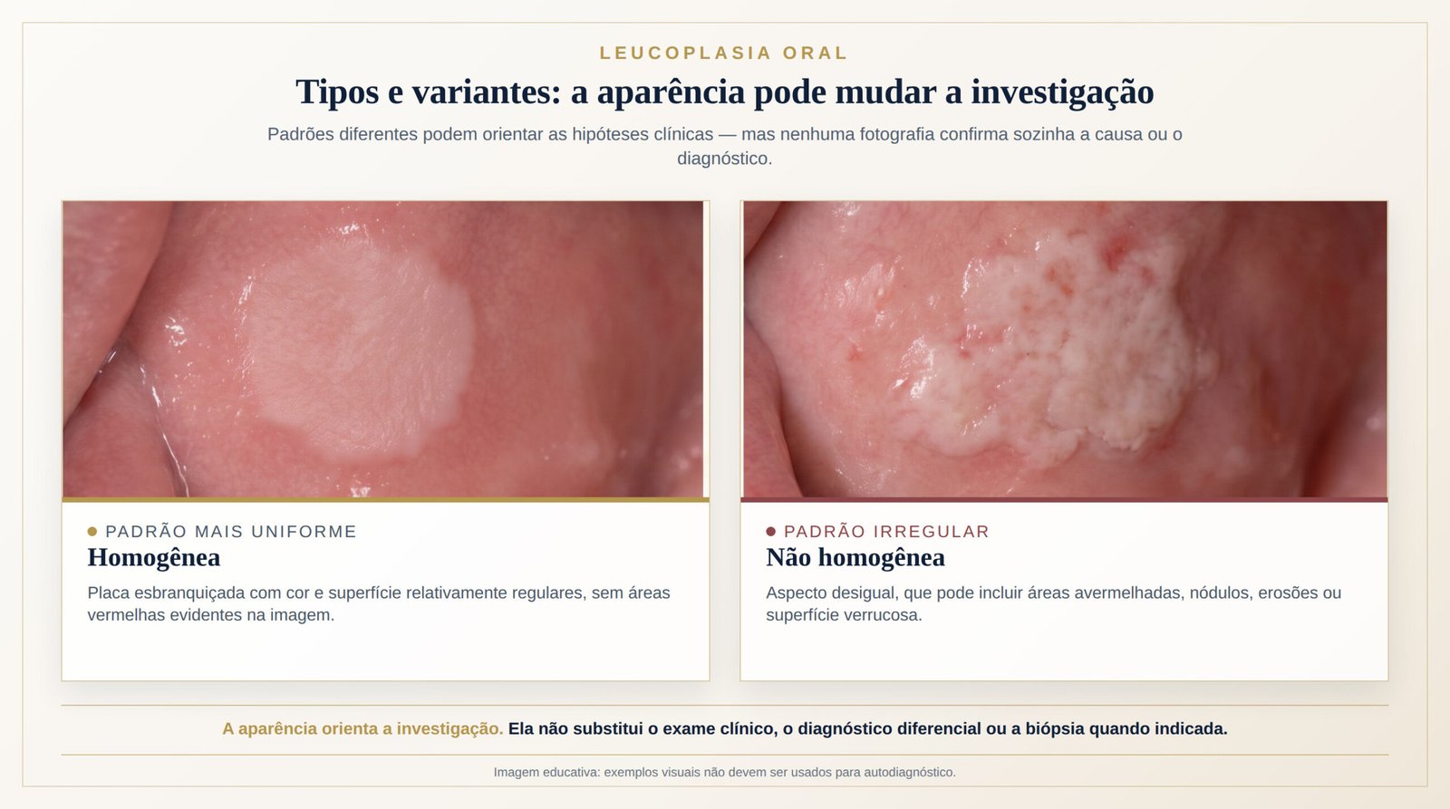 Infográfico comparando leucoplasia homogênea e não homogênea, com superfície uniforme de um lado e áreas vermelhas, nódulos ou aspecto verrucoso do outro