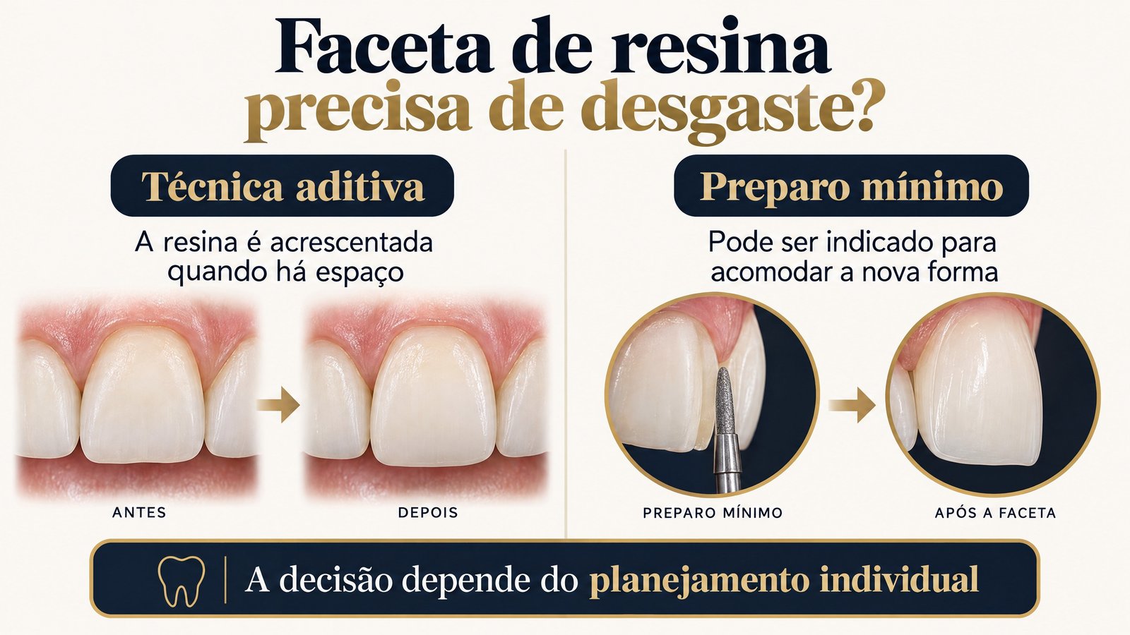 Infográfico compara técnica aditiva e preparo mínimo na faceta de resina.