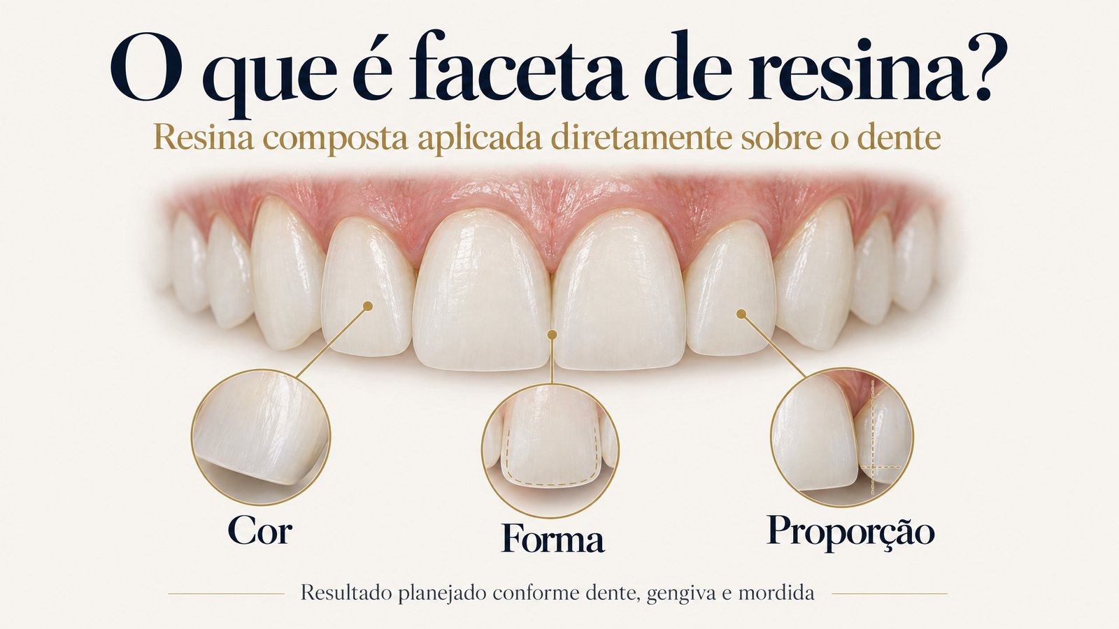 Infográfico explica que a faceta de resina é planejada para ajustar cor, forma e proporção do dente.
