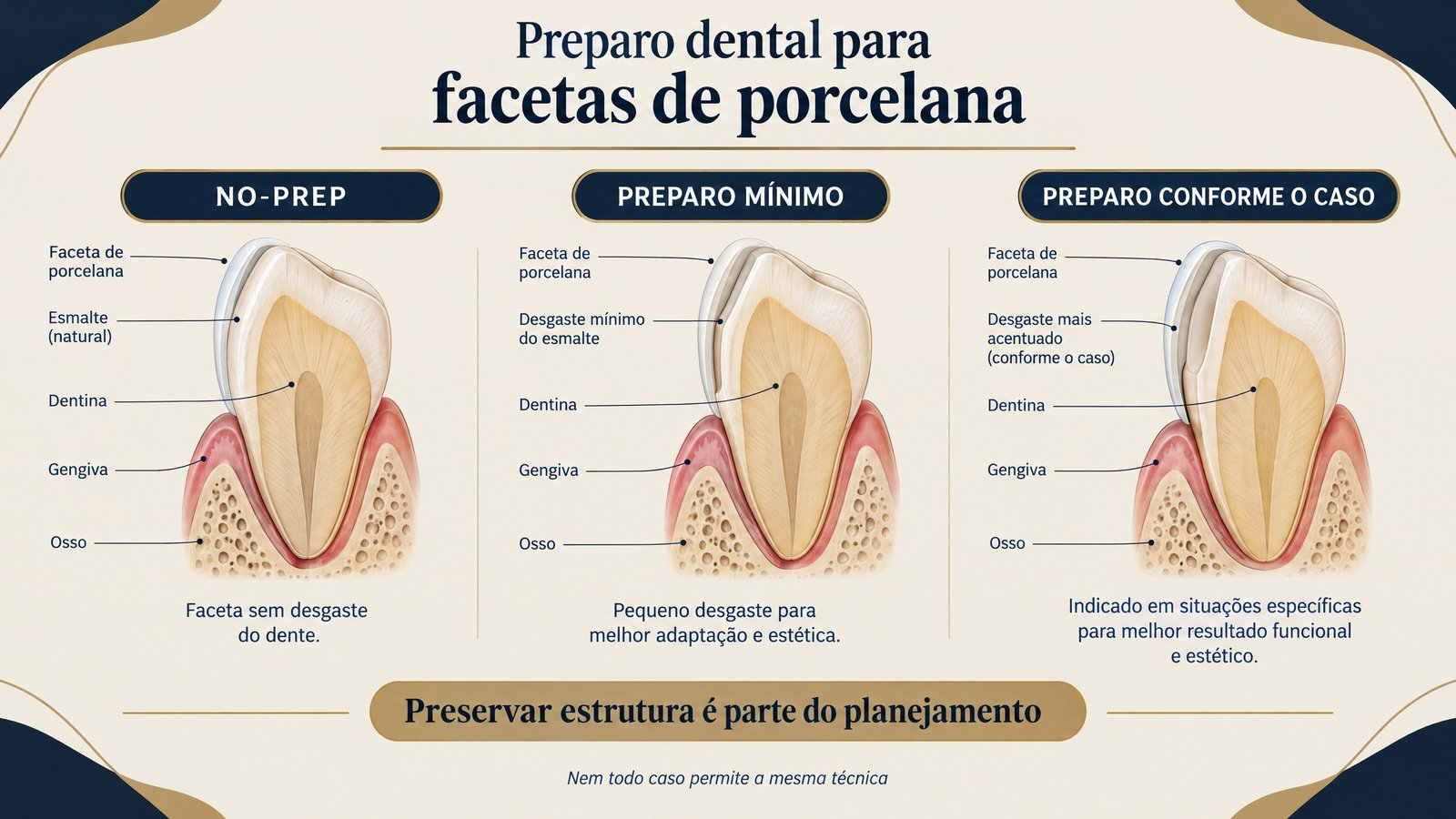 Infográfico comparando no-prep, preparo mínimo e preparo conforme o caso para laminados de porcelana, com foco na preservação da estrutura dental.